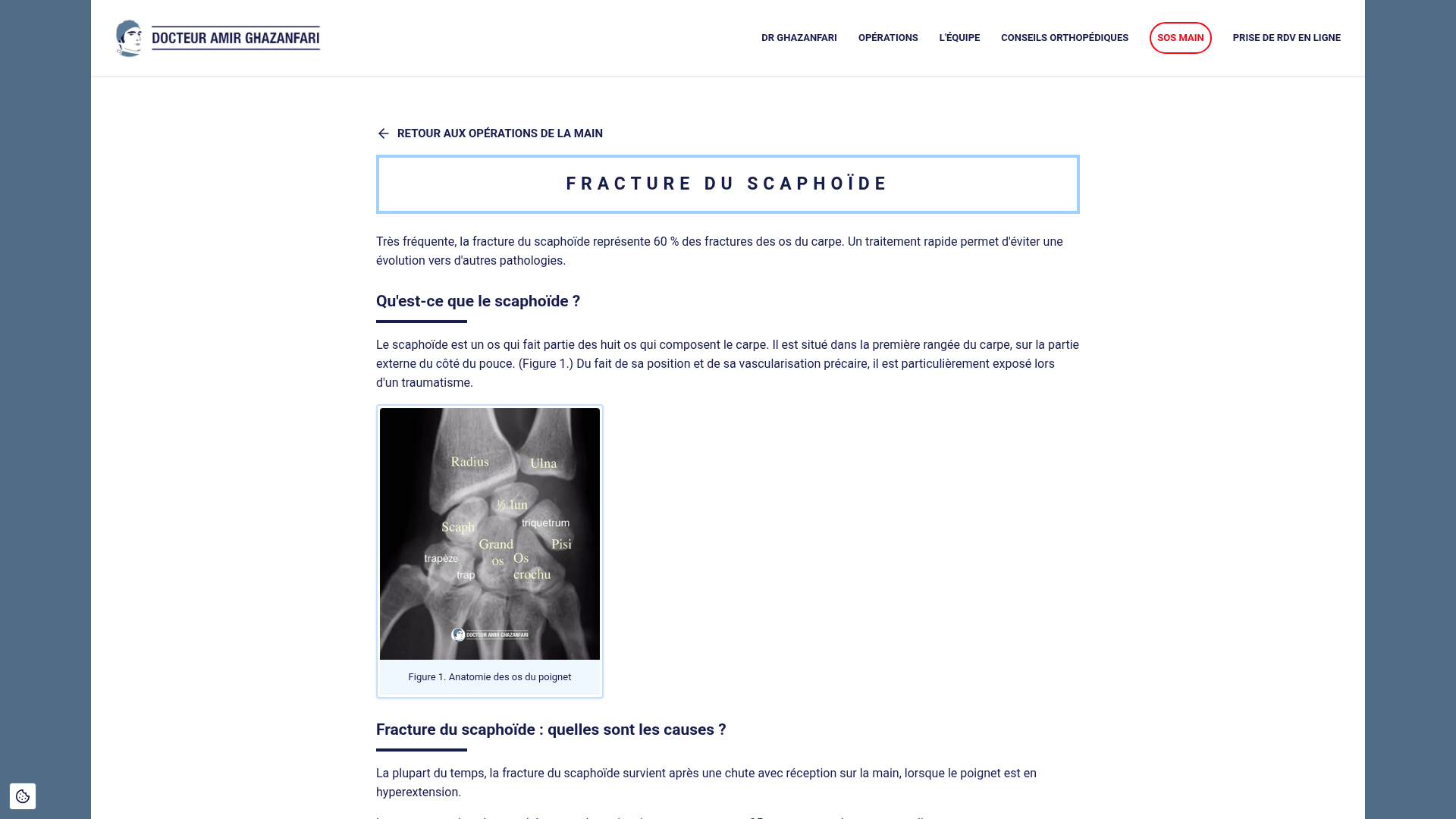 fracture scaphoïde attelle